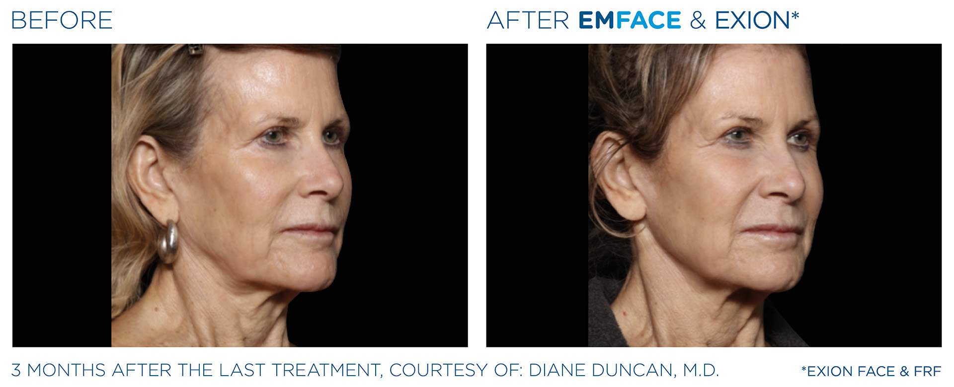 Microneedling Dentist Mansfield Texas