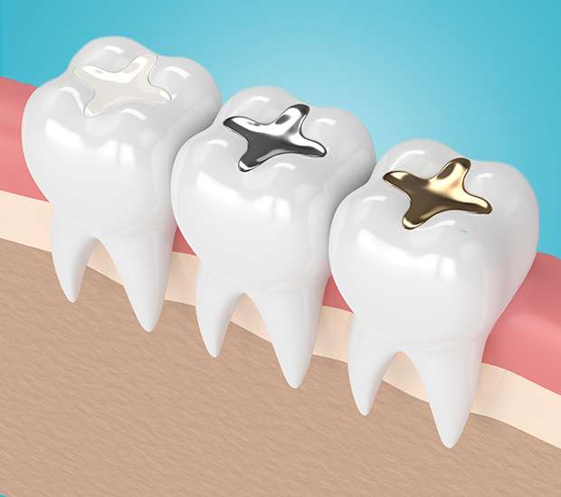 Mansfield Composite Fillings