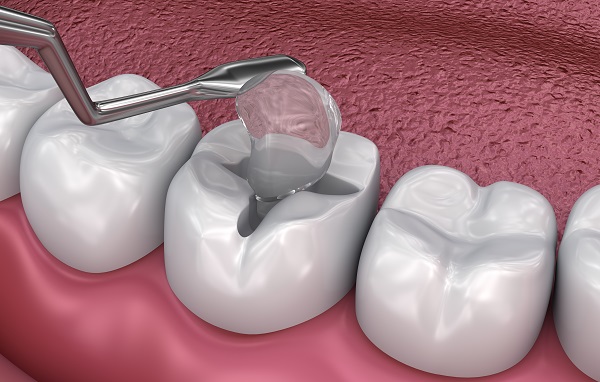 How Long Do Dental Fillings Last?