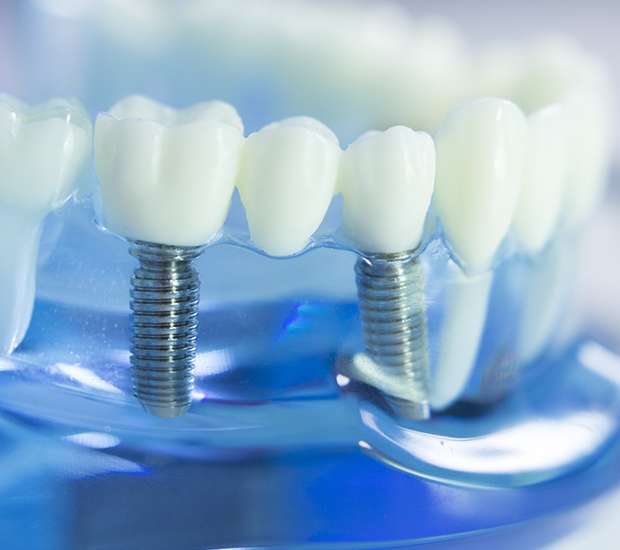 Mansfield Dental Implants