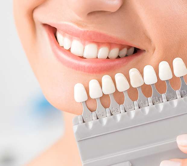 Mansfield Dental Veneers and Dental Laminates