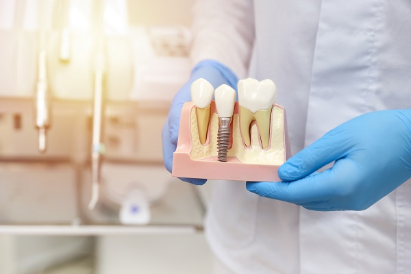 A Step By Step Guide To Implant Restoration