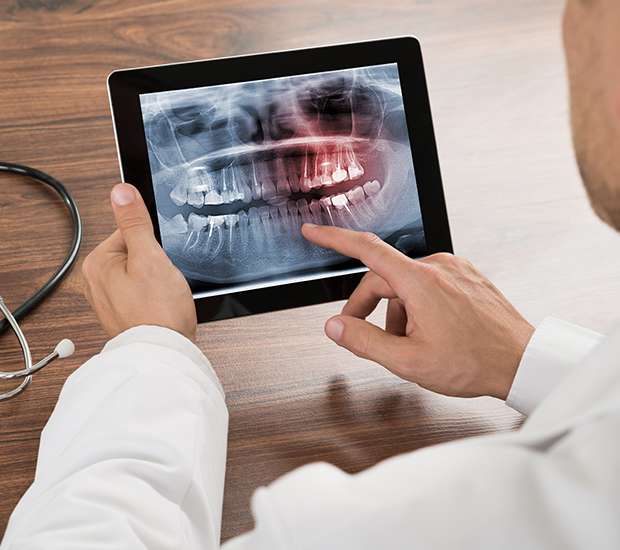 Mansfield Types of Dental Root Fractures