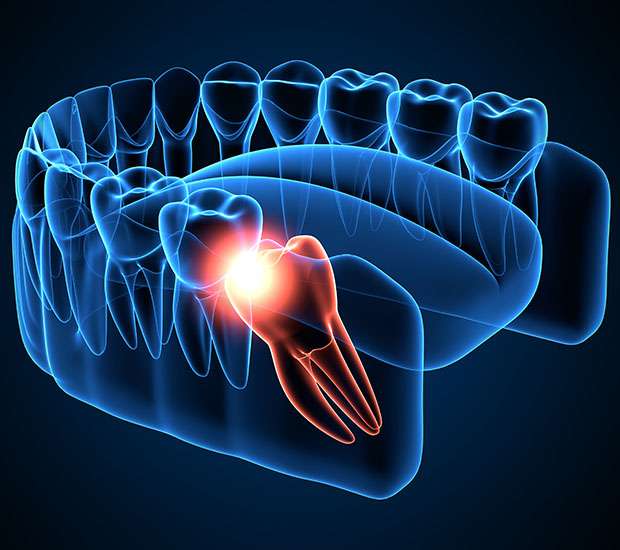 Mansfield Wisdom Teeth Extraction