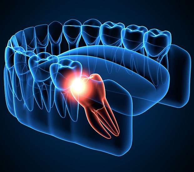 Mansfield Wisdom Teeth Extraction